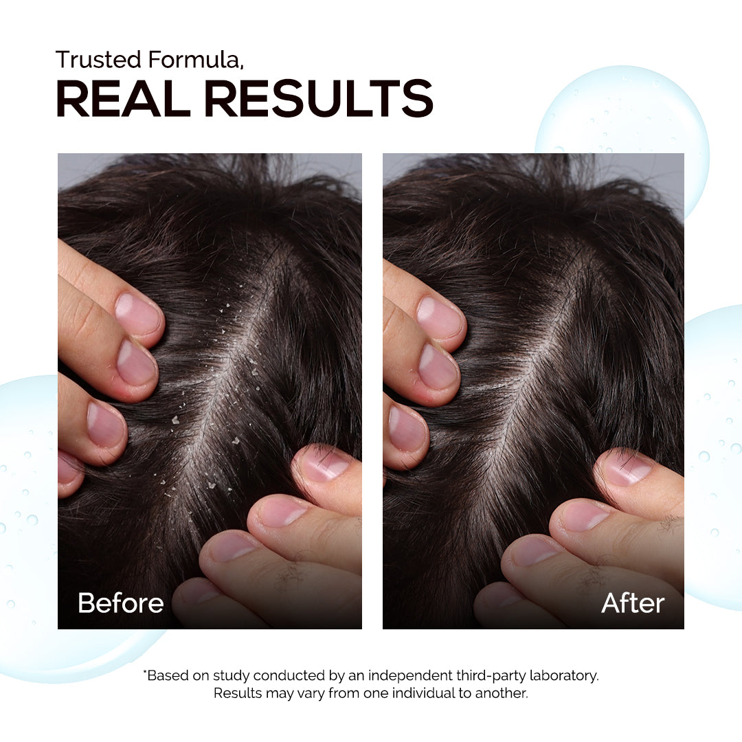 KORE Anti-Dandruff 2% Ketoconazole Hydrating Shampoo | Clinically Crafted for Up to 100% Dandruff Reduction | Powered with Hydraflake Technology | Ketoconazole, Pentavitin & Ichthyol Pale | Soothes Itchy, Irritated Scalp | 200 ml