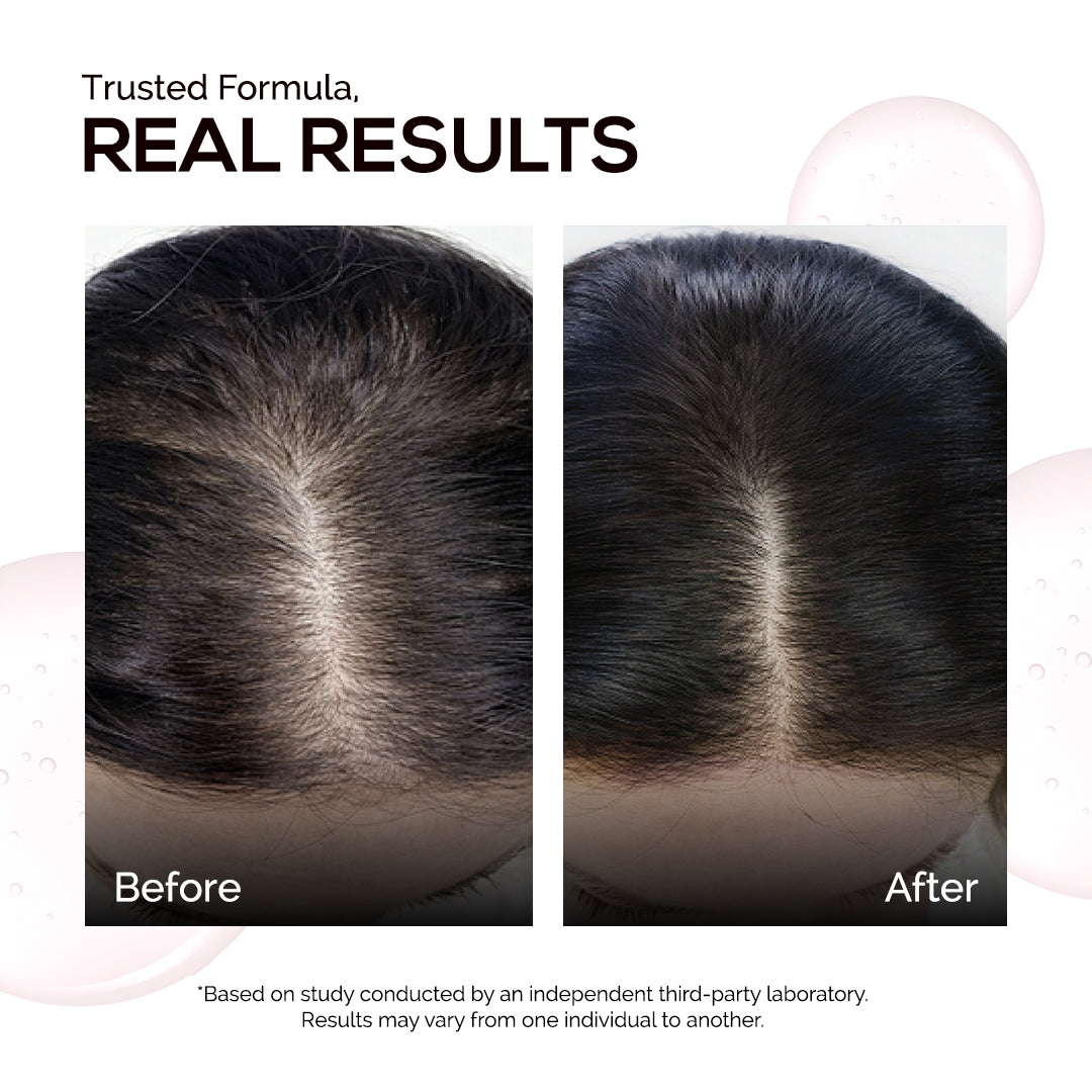 KORE Multi-Peptide Hair Growth Serum | Powered with Advanced Follicular Delivery System | 21 Actives with 3% Redensyl, 2% Anagain & Copper Tripeptide-1 | Boosts Hair Growth & Density | For Men & Women | 30 ml