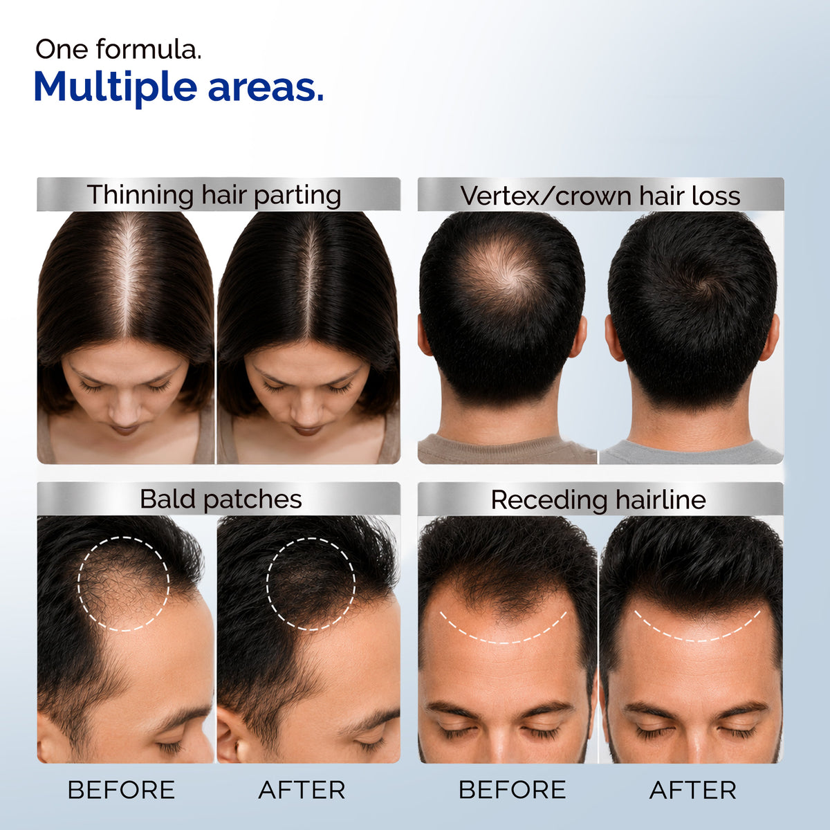 KORE 10% Minoxidil and 0.1% Finasteride Lipid Topical Solution