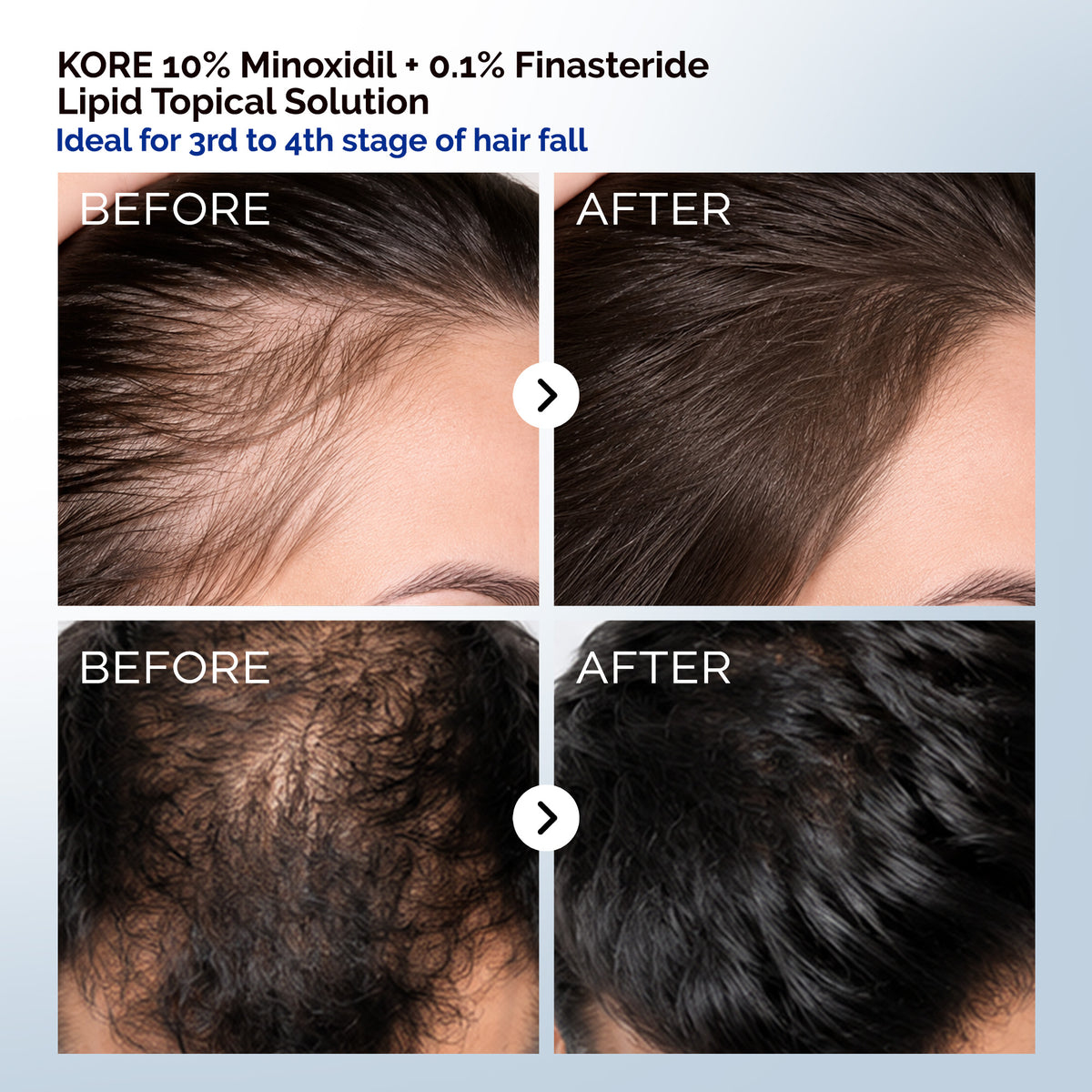 KORE 10% Minoxidil and 0.1% Finasteride Lipid Topical Solution