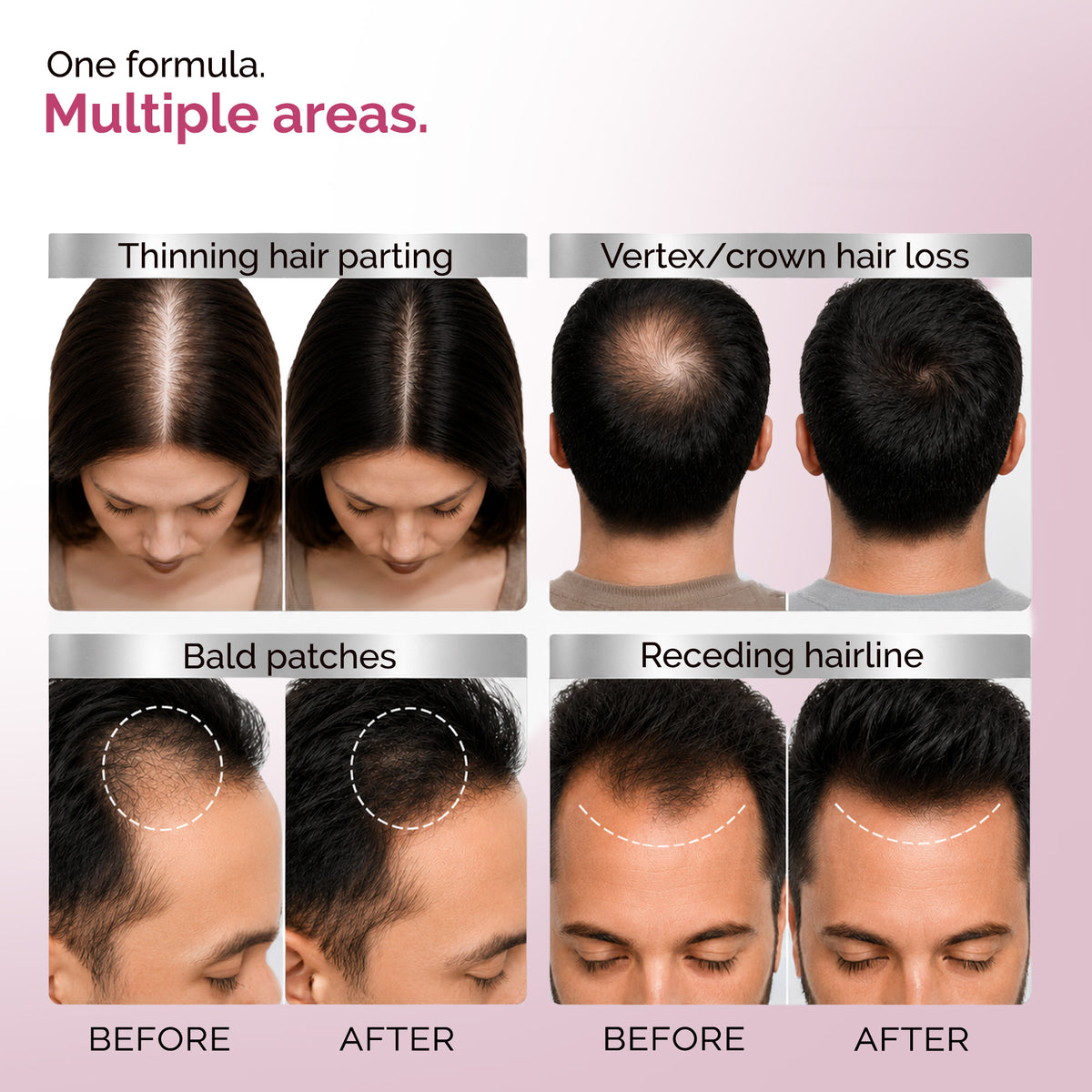 KORE Hair Growth Treatment | 2% Minoxidil Lipid Topical Solution | 60 ml