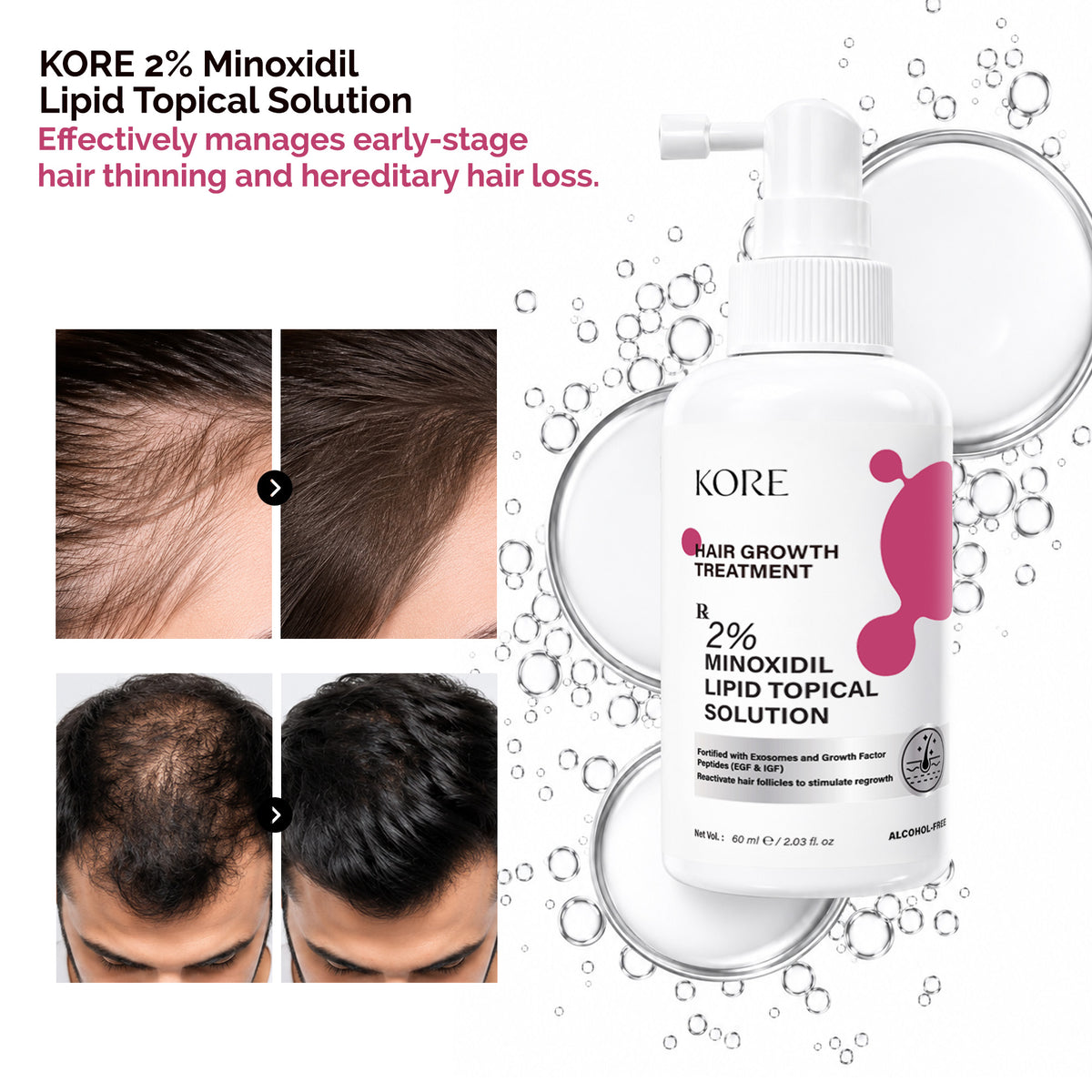 KORE Hair Growth Treatment | 2% Minoxidil Lipid Topical Solution | 60 ml