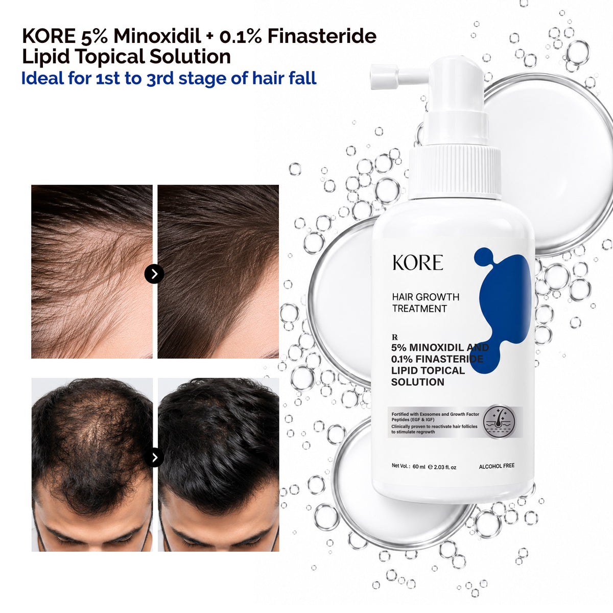 KORE 5% Minoxidil and 0.1% Finasteride Lipid Topical Solution